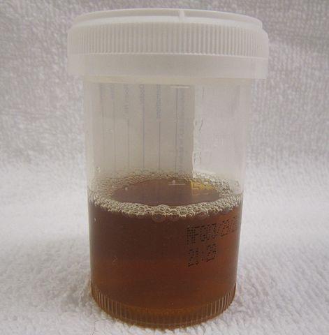 Urina de pessoa com rabdomiólise. (Fonte: WikimediaCommons/Reprodução)